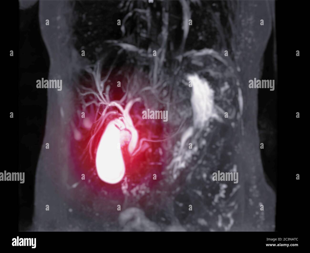 Magnetic resonance cholangiopancreatography or MRCP 3D MIP image Magnetic resonance cholangiopancreatography or MRCP 3D MIP image