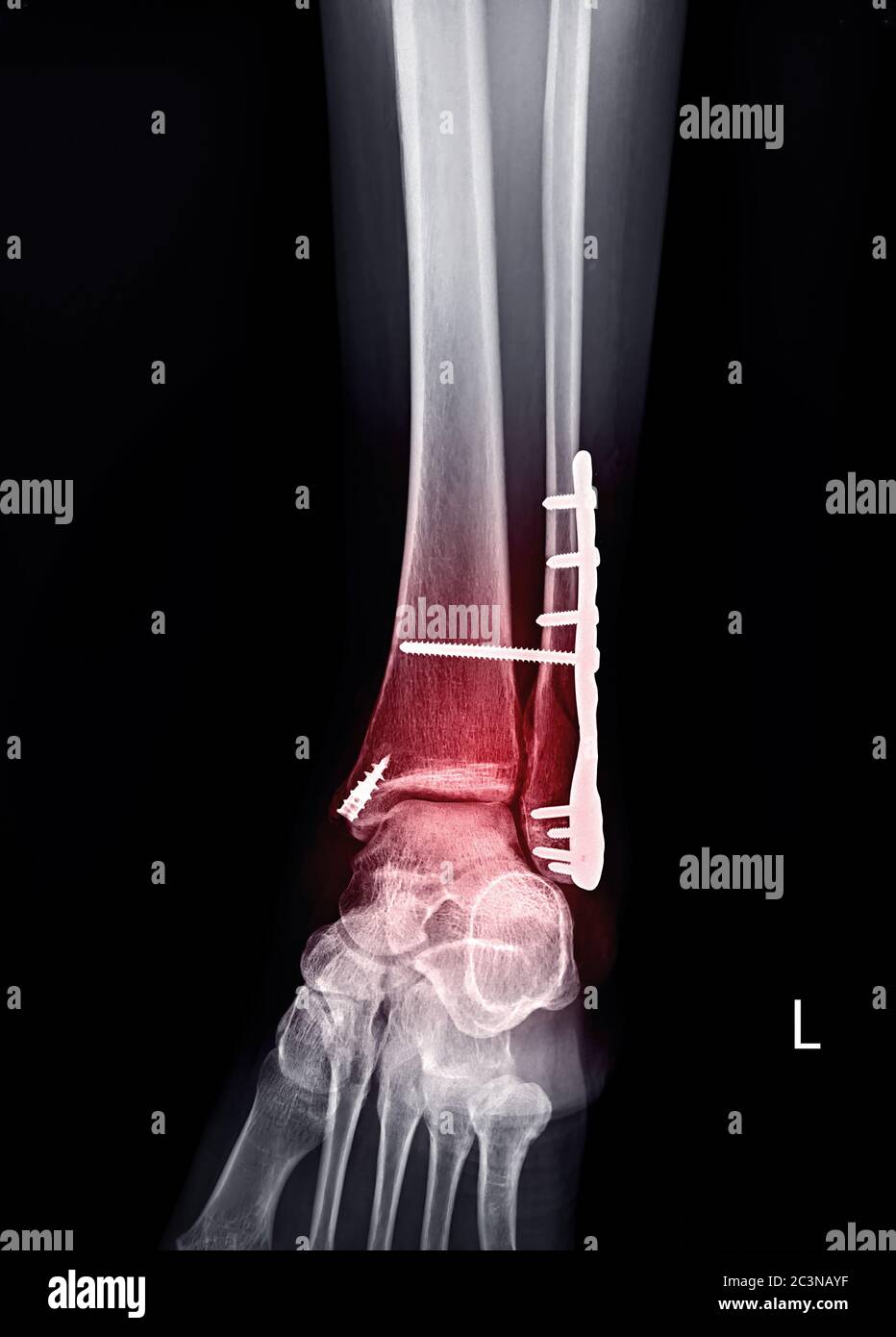 X-ray ankle or Radiographic image or x-ray image of left ankle joint  AP view  showing ankle plate and screws surgery with fracture fibula bone. Stock Photo