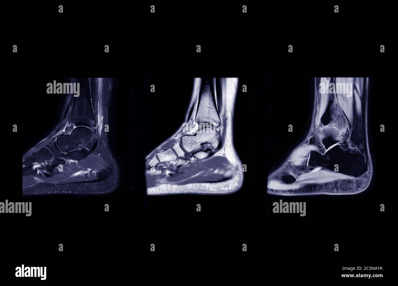 mri of torn tendon in left ankle