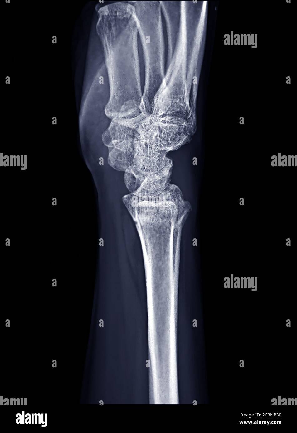 Xray image of Right wrist joint Lateral view for diagnosis rheumatoid arthritis Stock Photo Alamy