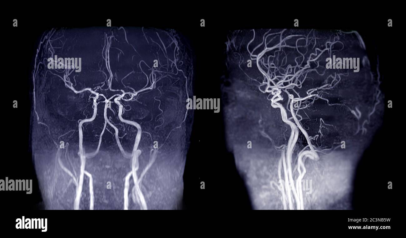 MRA Brain or Magnetic resonance angiography ( MRA ) of cerebral artery and  common carotid artery AP and Lateral View for evaluate them stenosis an  Stock Photo - Alamy
