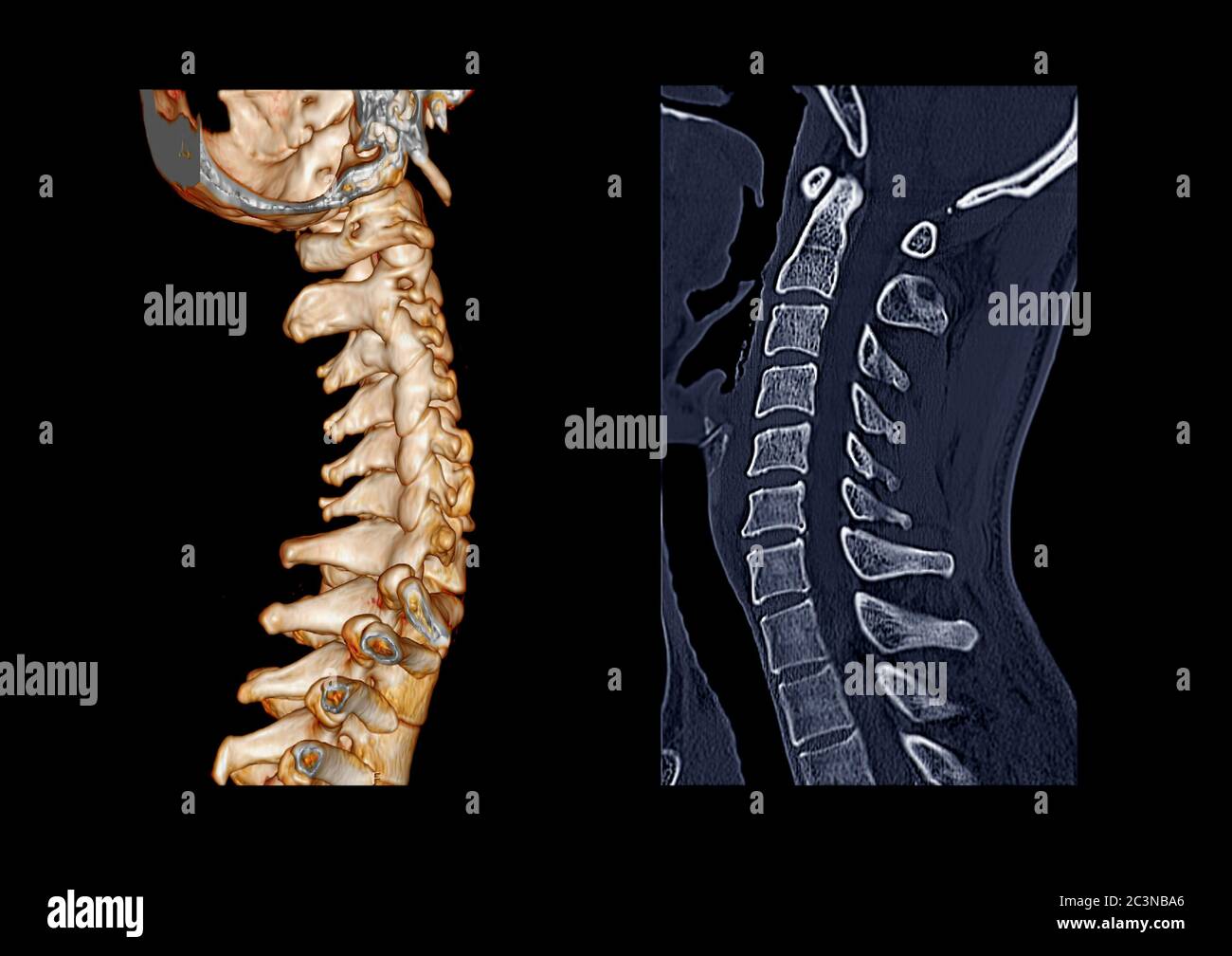 Compare of CT C-Spine or Cervical spine  3D Rendering image  and sagittal  view in patient trauma cervical spine injury. Stock Photo