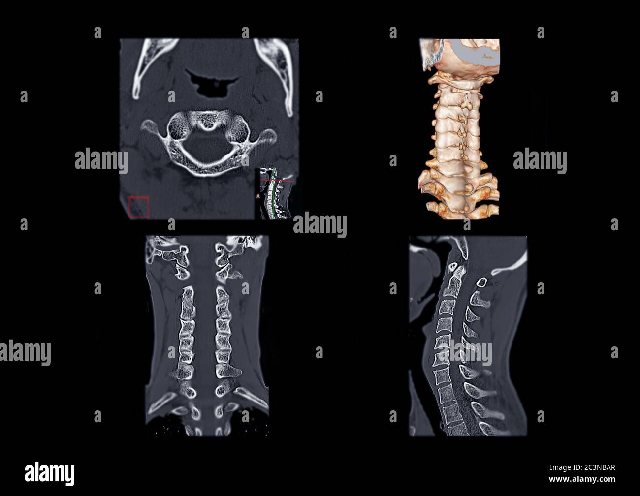 Compare of CT C-Spine or Cervical spine axial view , 3D Rendering image , Corona and sagittal  view in patient trauma cervical spine injury. Stock Photo