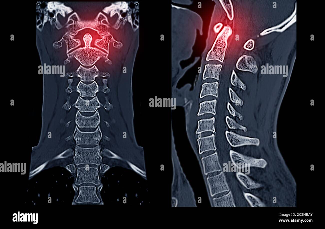 CT C-Spine or Cervical spine  Coronal view in patient trauma cervical spine injury showing odontoid process or dens. Stock Photo