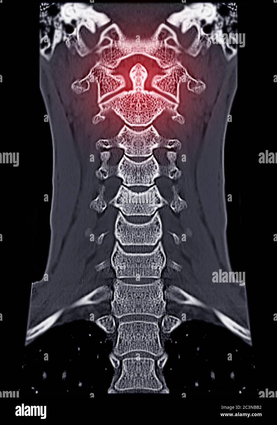 CT C-Spine or Cervical spine  Coronal view in patient trauma cervical spine injury showing odontoid process or dens. Stock Photo