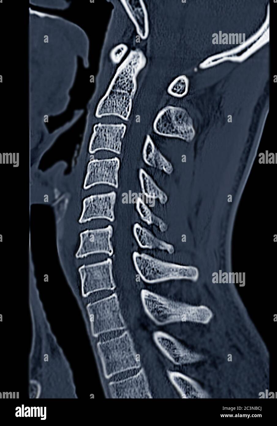 CT C-Spine or Cervical spine  sagittal  view in patient trauma cervical spine injury. Stock Photo