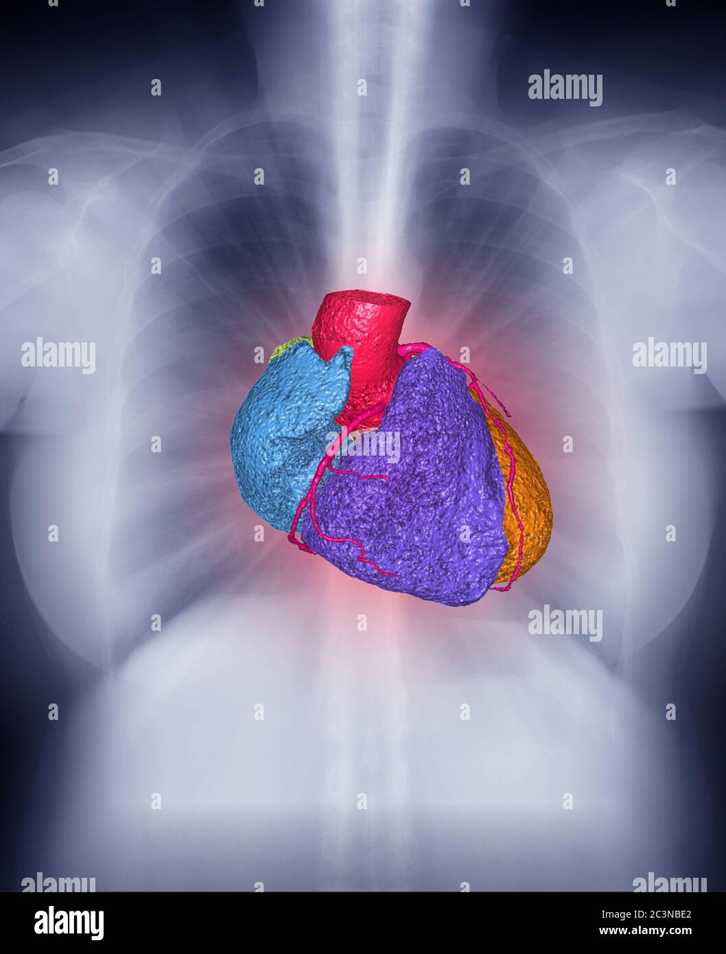 Fusion image of Chest Xray image and 3D CTA Coronary artery Image