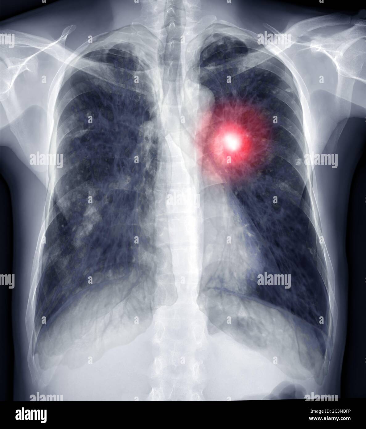 Chest xray fusion image with CT Chest or Lung 3D rendering image for