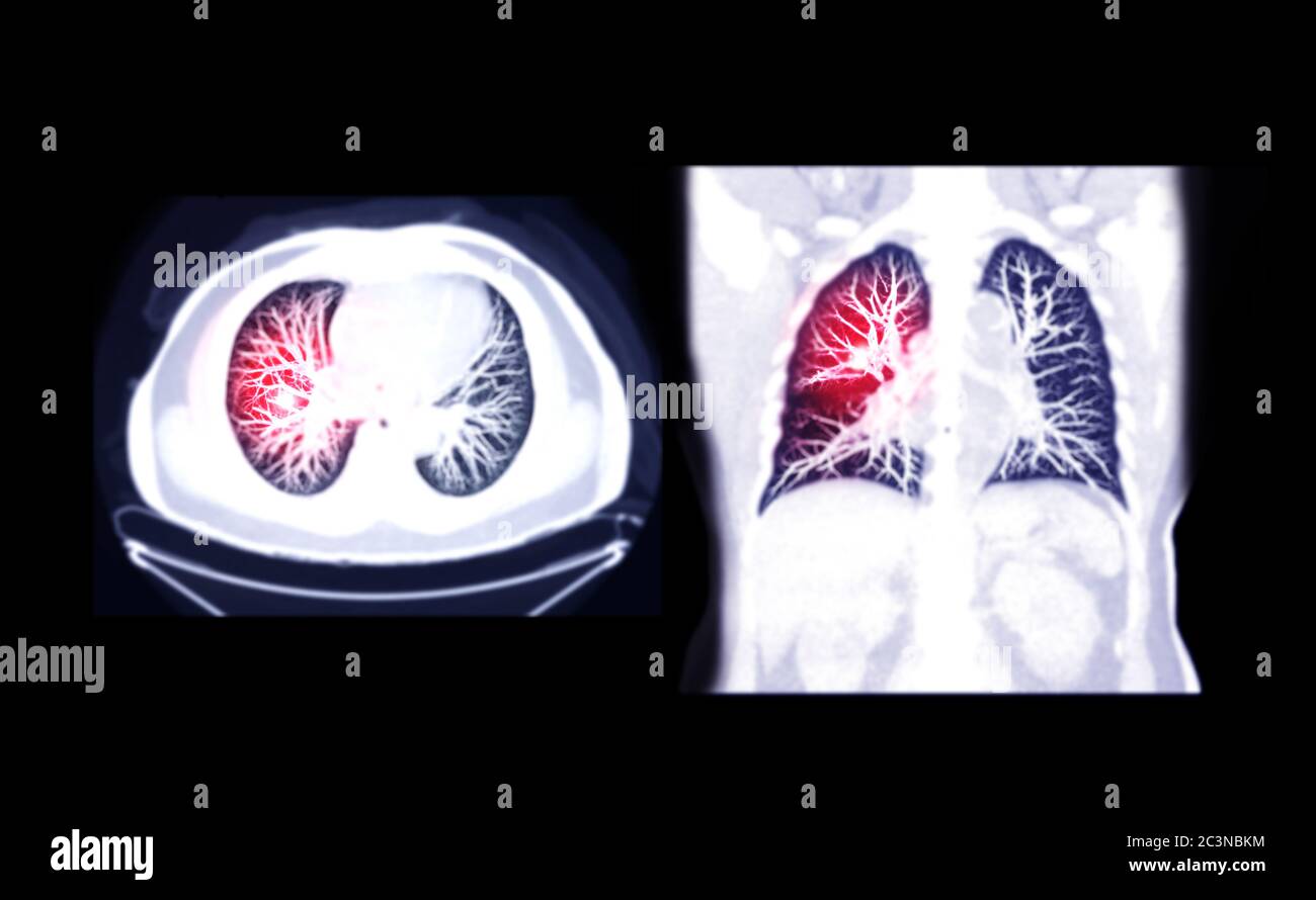 Selective Focus of CT Chest AXIAL and Coronal MIP view for diagnostic Pulmonary embolism (PE) , lung cancer and covid-19. . Stock Photo