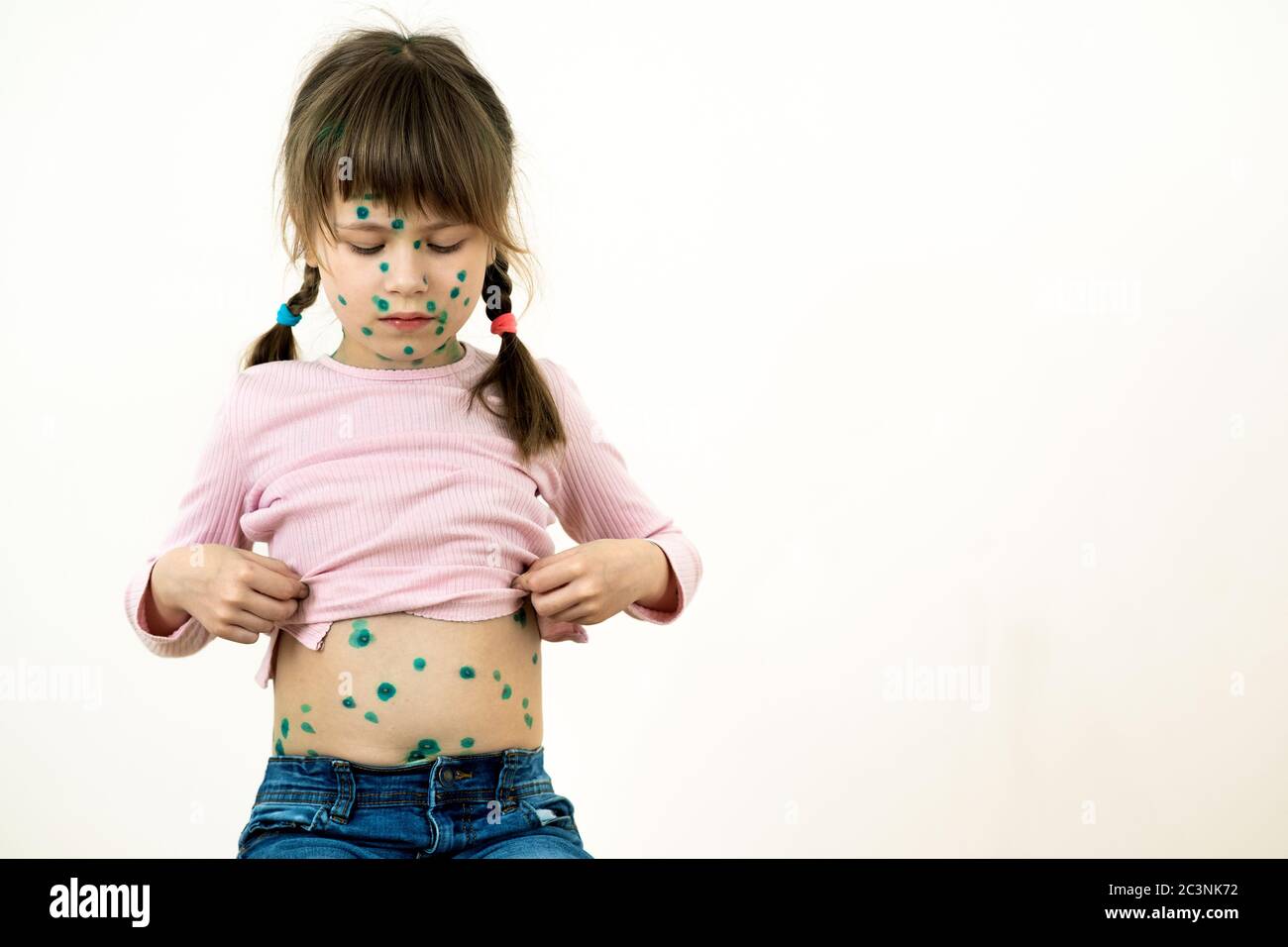 Child girl covered with green rashes on face and stomach ill with chickenpox, measles or rubella virus. Stock Photo