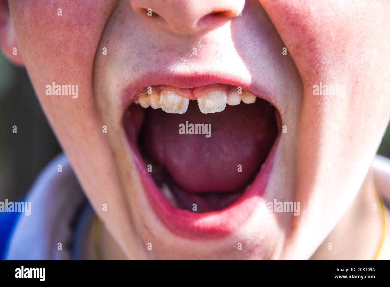 Toddler with mouth opened wide to show lower baby teeth at dental check