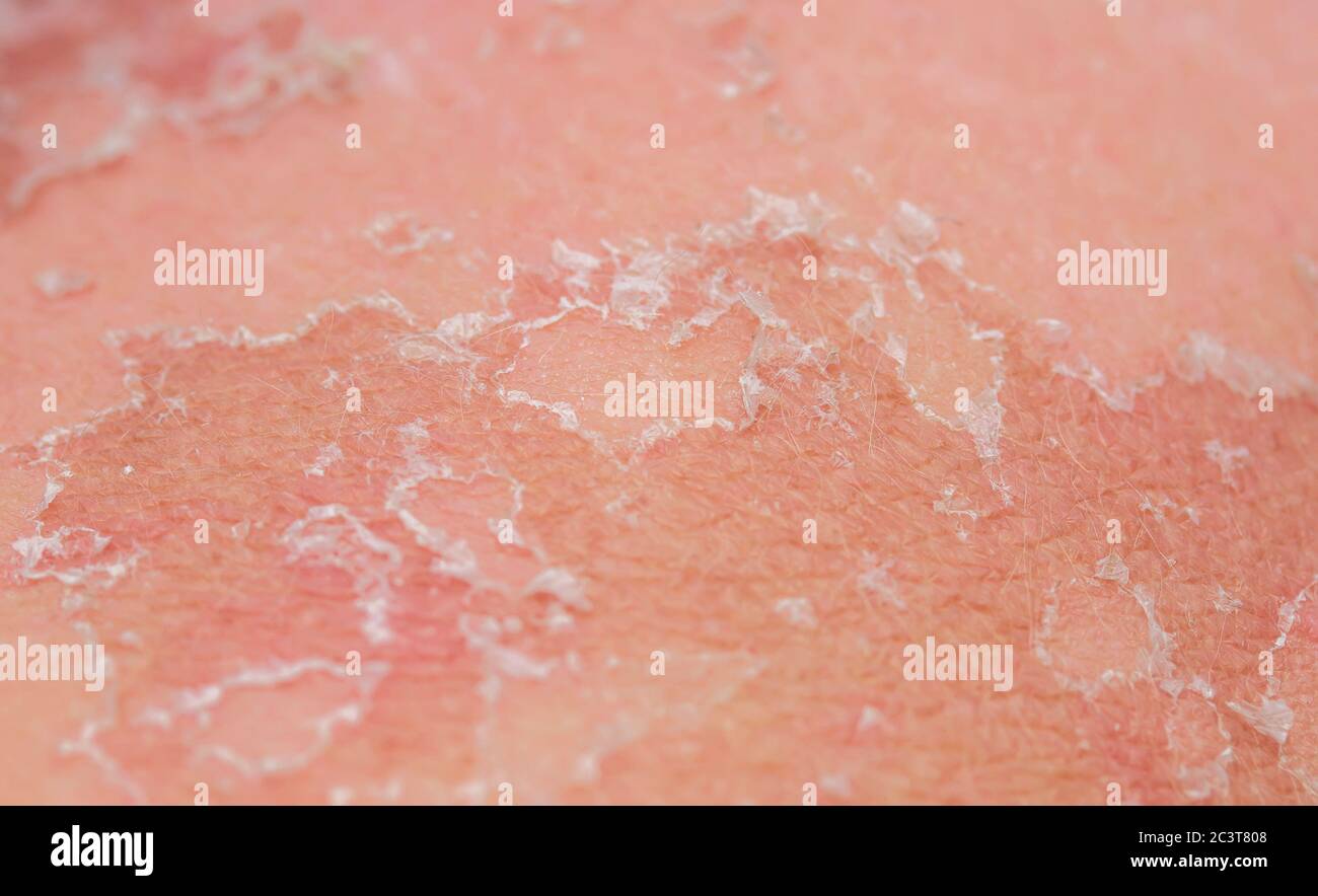 texture of irritated skin with cracks of dead cells and redness after sunburn and allergies on the human body Stock Photo