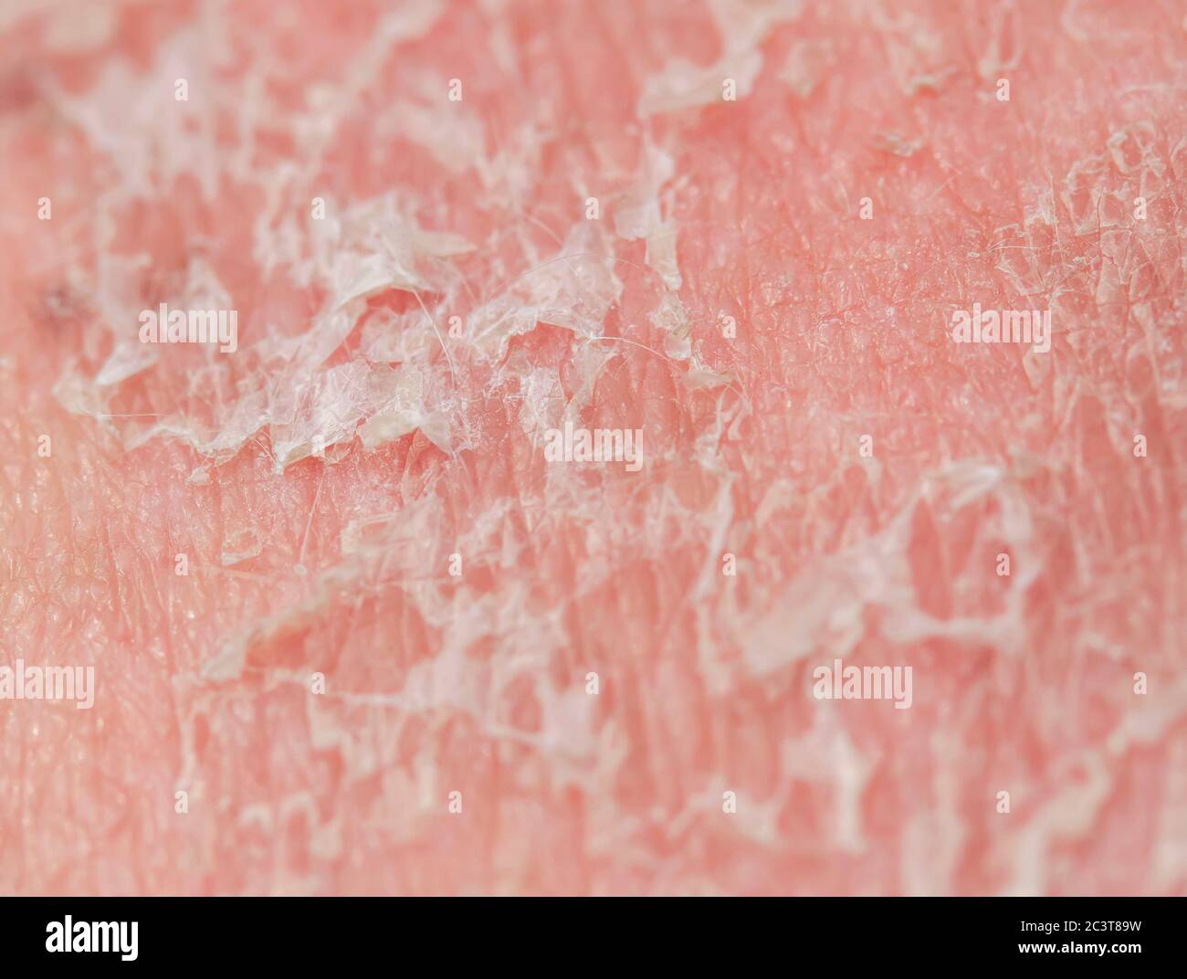 texture of irritated unhealthy skin with scales of dead cells and redness after sunburn and allergies on the human body Stock Photo