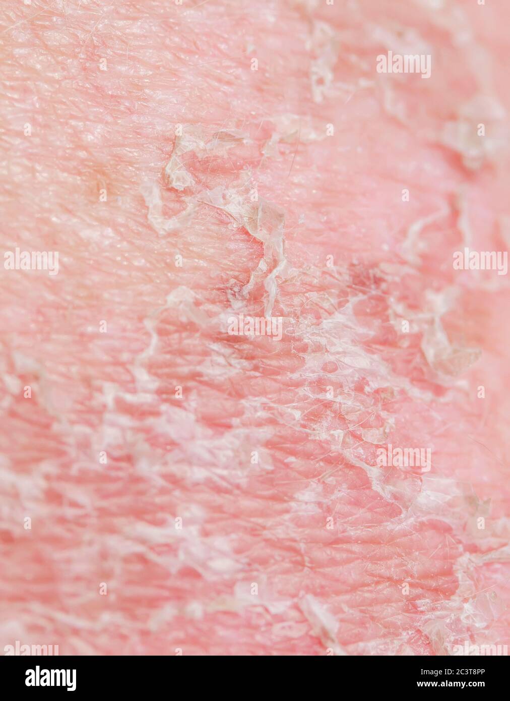 vertical background with the texture of irritated skin with cracks of