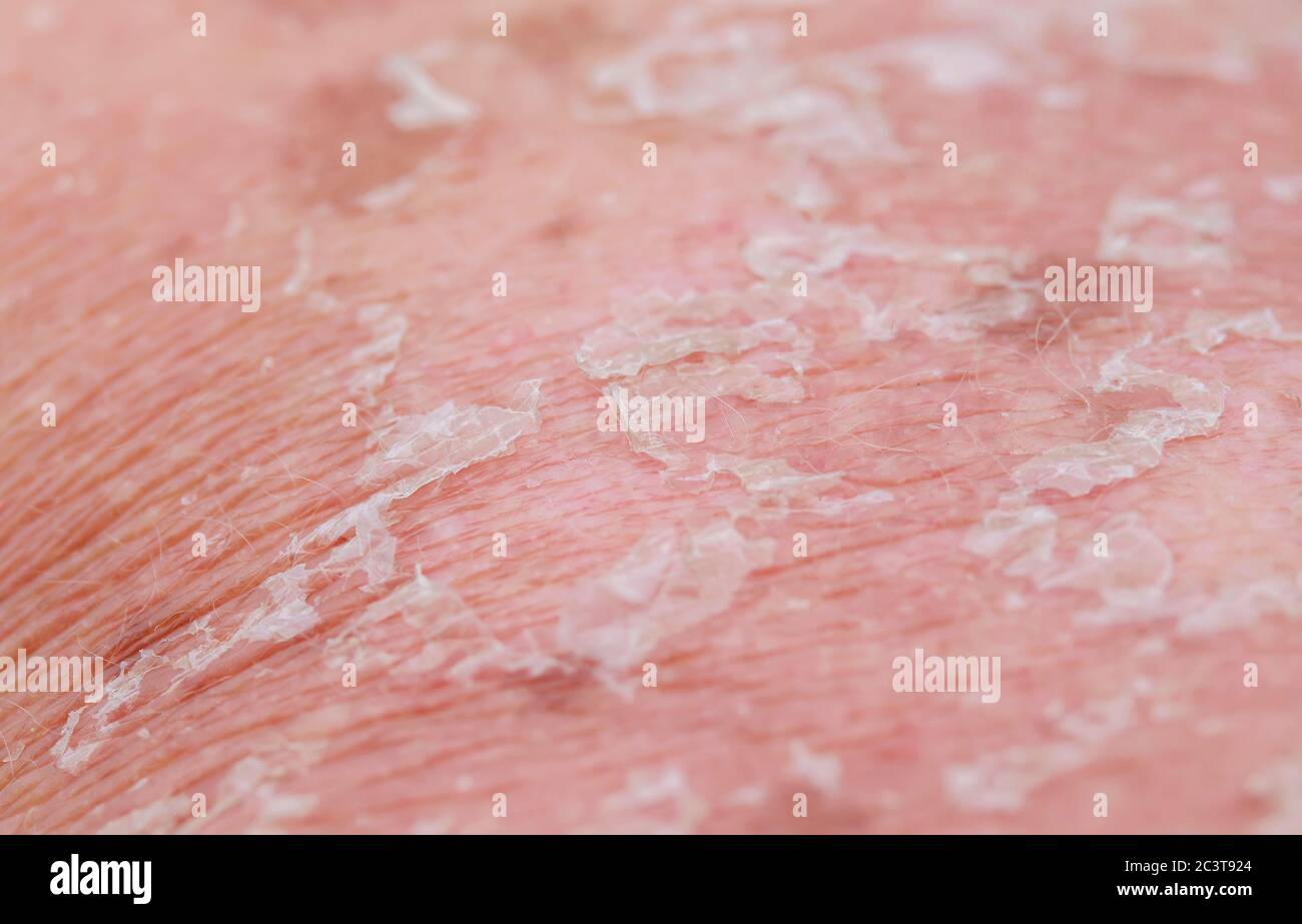 textured background with scales of dead skin cells with cracks and redness after sunburn come off the body Stock Photo