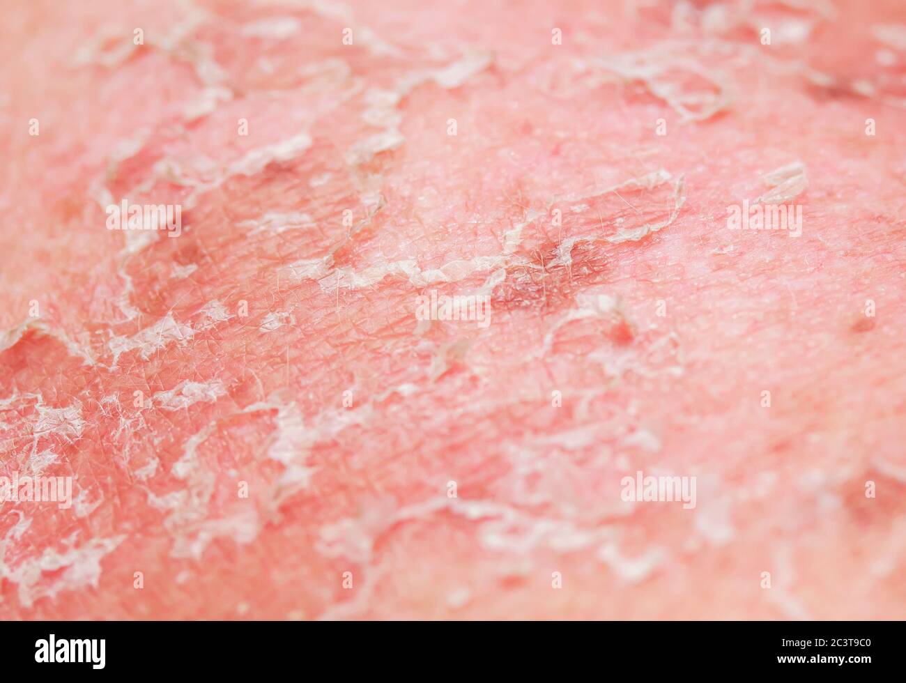 texture of irritated reddened skin with flaking scales and cracks from sunburn and allergies on the human body Stock Photo