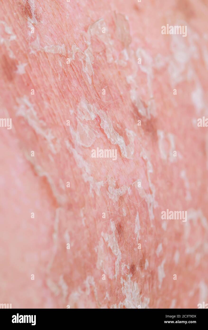 texture of irritated unhealthy skin with scales of dead cells and redness after sunburn and allergies leave the body Stock Photo