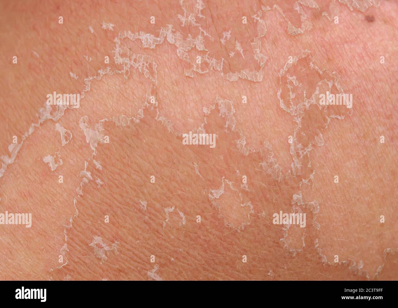 skin texture with scales of dead cells and redness after sunburn come off the body Stock Photo