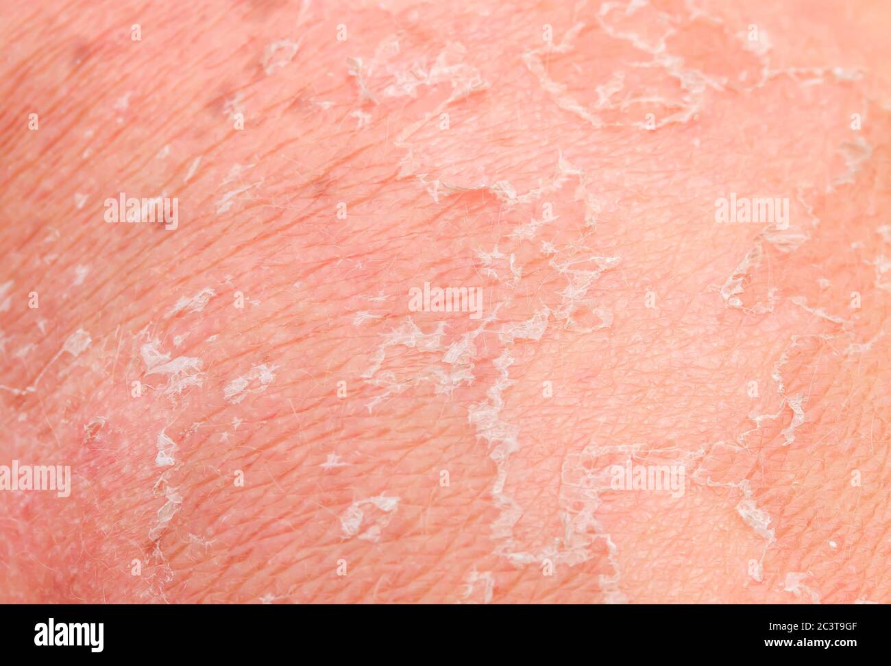 textured background with scales of dead skin cells with redness and pigmentation after sunburn are detached from the body Stock Photo
