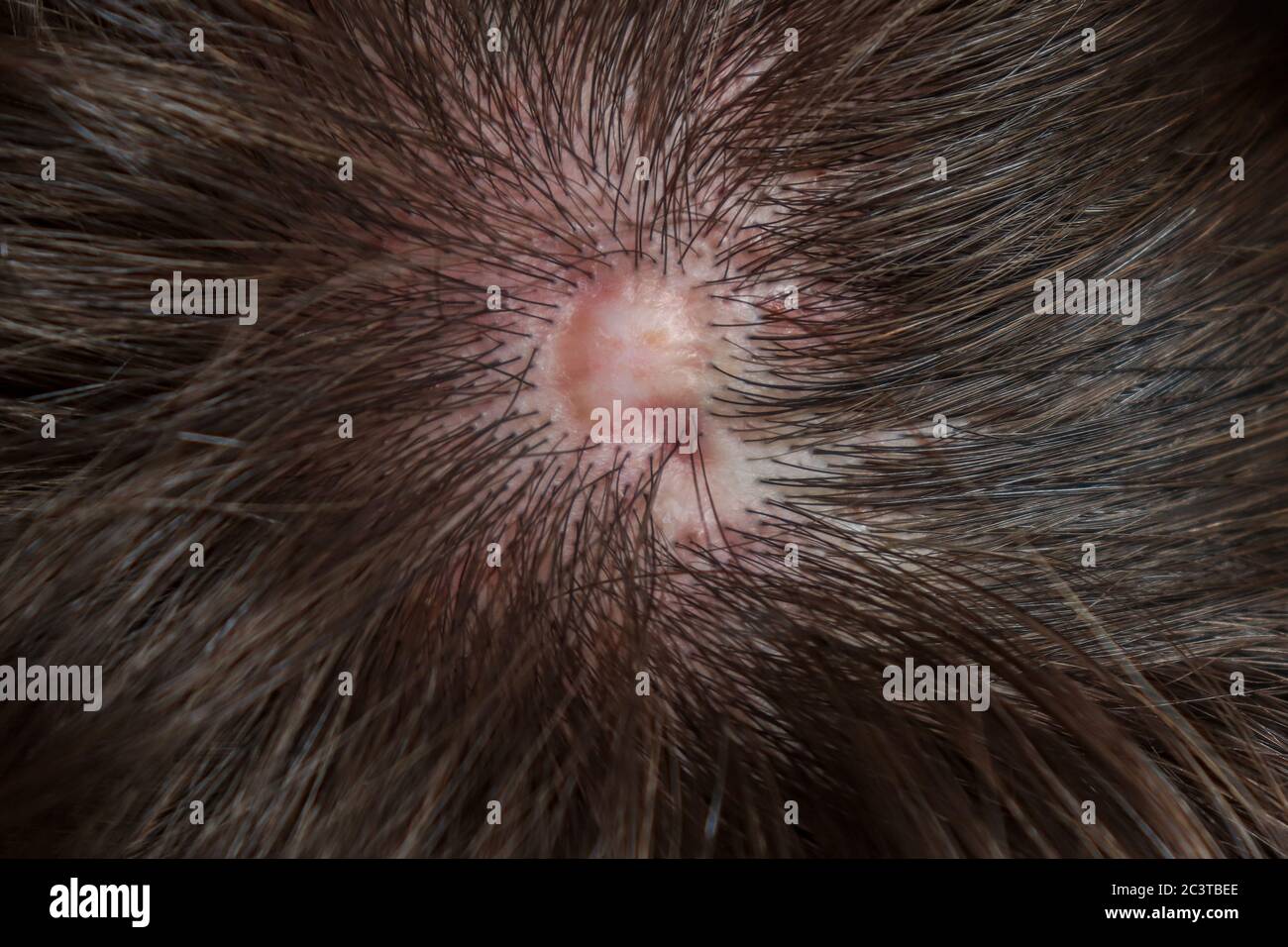 Aplasia cutis congenita hi-res stock photography and images - Alamy