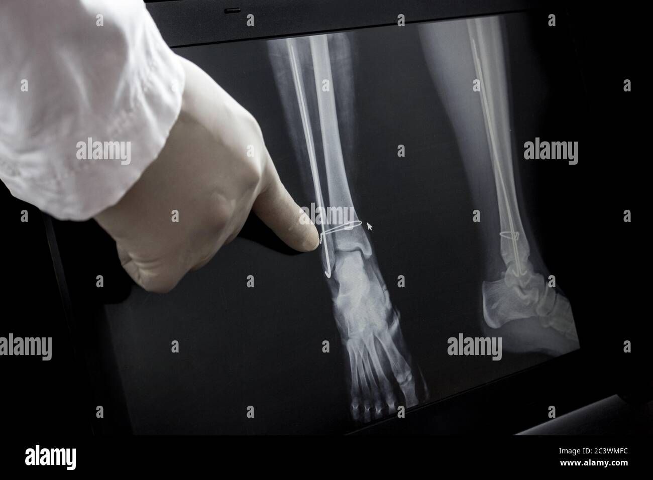 X-ray of the leg after surgery - wires in the leg. The doctor points a finger at the operated area. Stock Photo