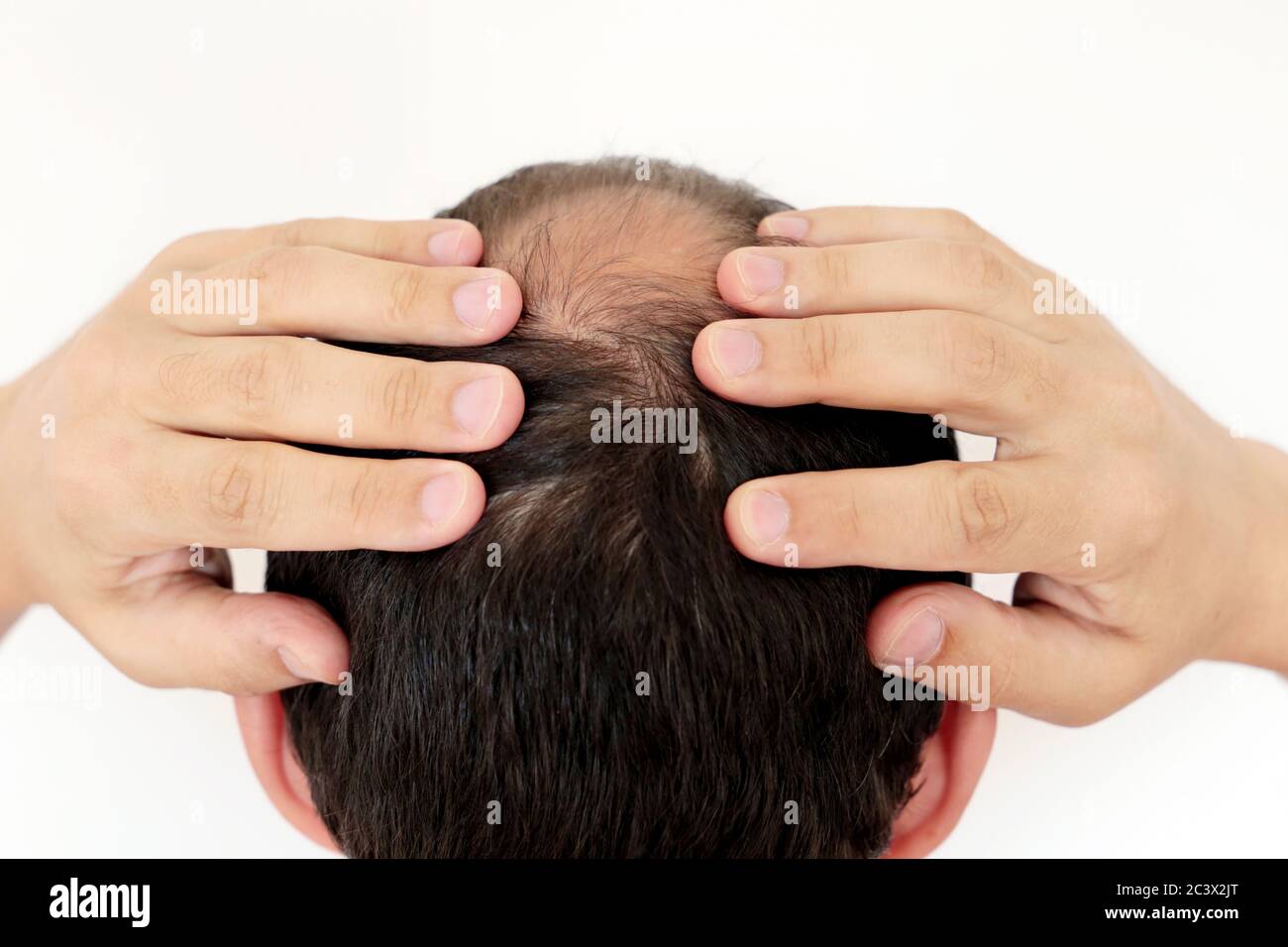 Baldness, man concerned about hair loss. Male head with a bald on white background Stock Photo