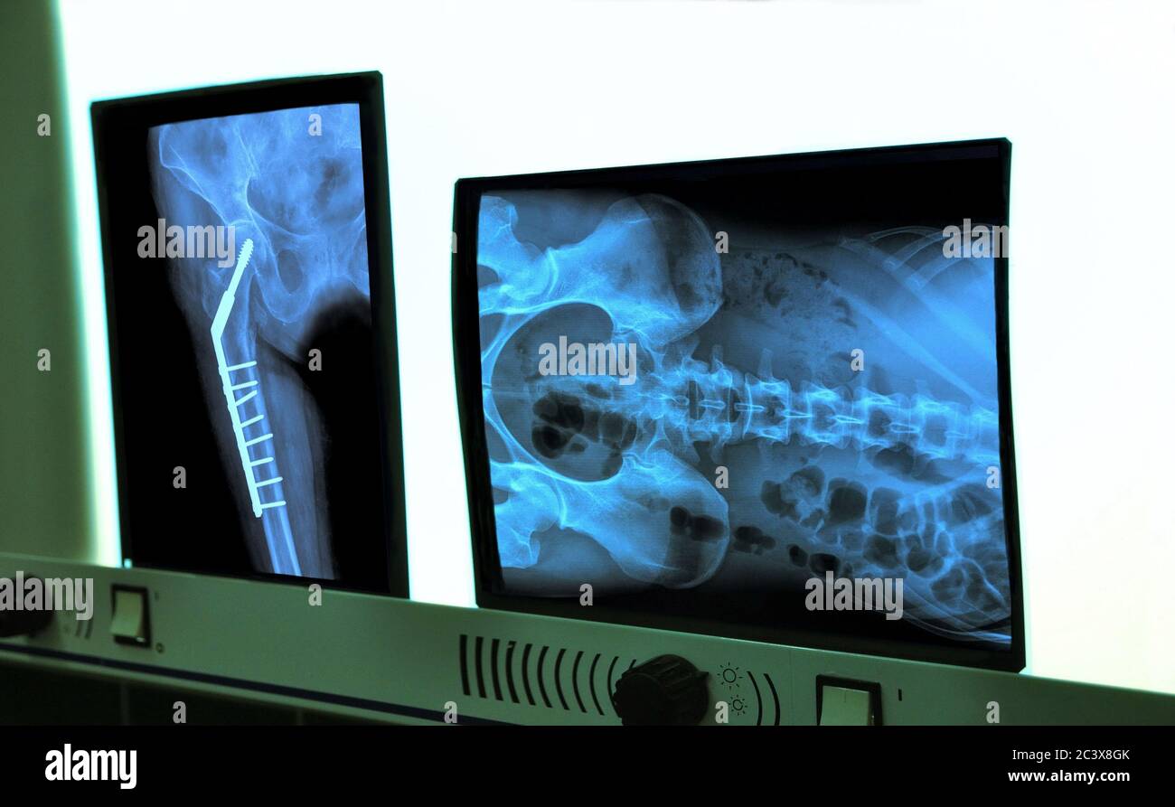 negatoscope with xray of hip and spine Stock Photo