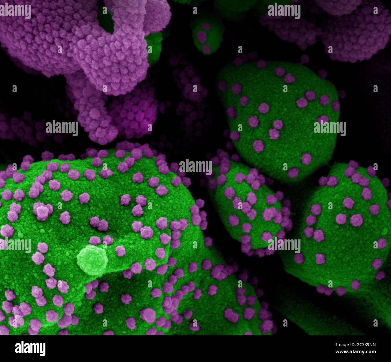 Novel Coronavirus SARS-CoV-2 Colorized scanning electron micrograph of an apoptotic cell (green) heavily infected with SARS-COV-2 virus particles (purple), isolated from a patient sample. Image at the NIAID Integrated Research Facility (IRF) in Fort Detrick, Maryland. Stock Photo