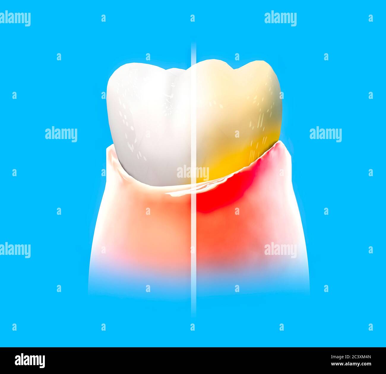 Tooth, sore gum, redness, dentistry, dental cleaning, oral hygiene