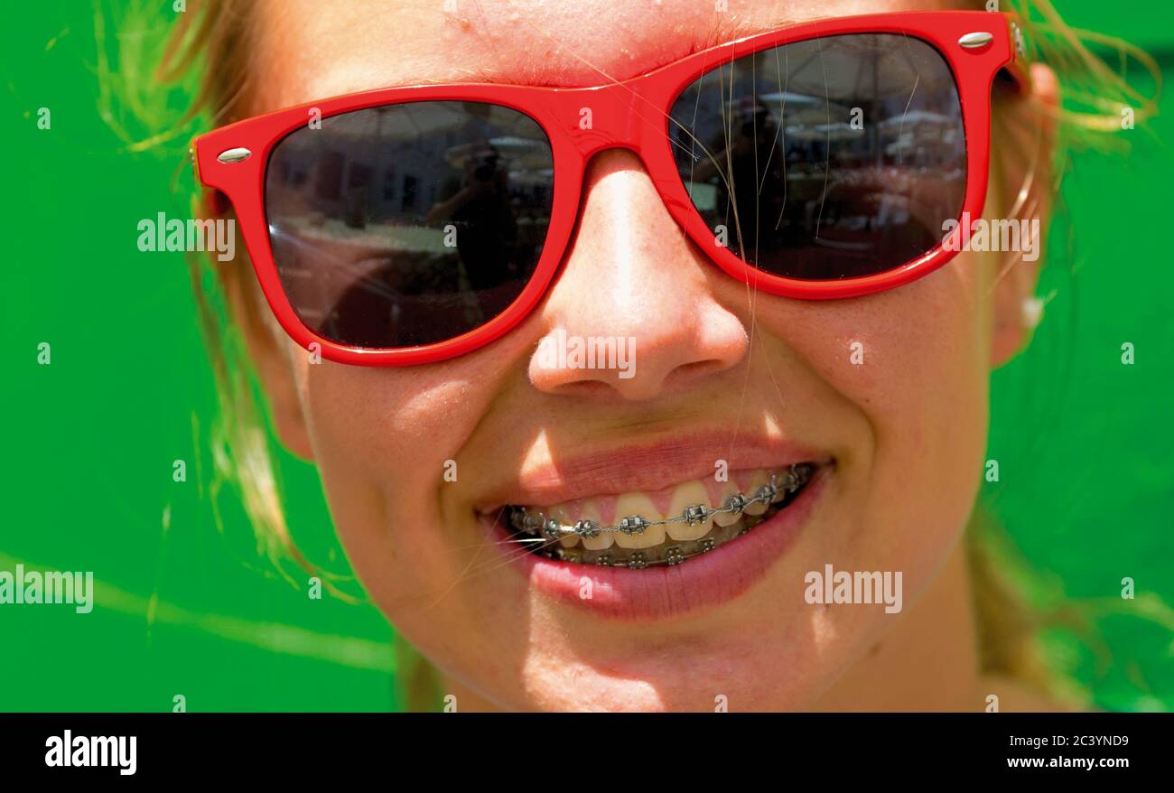Happy teenage girl with braces on teeth and acne. Stock Photo