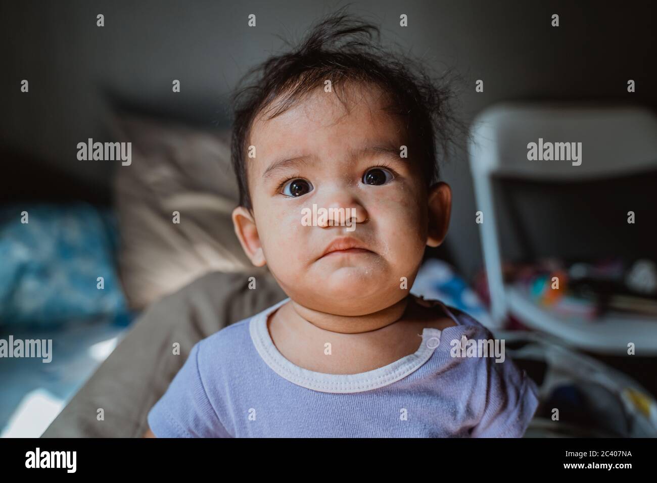 portrait of asian baby with skin rashes from allergies or irritation and itchy Stock Photo