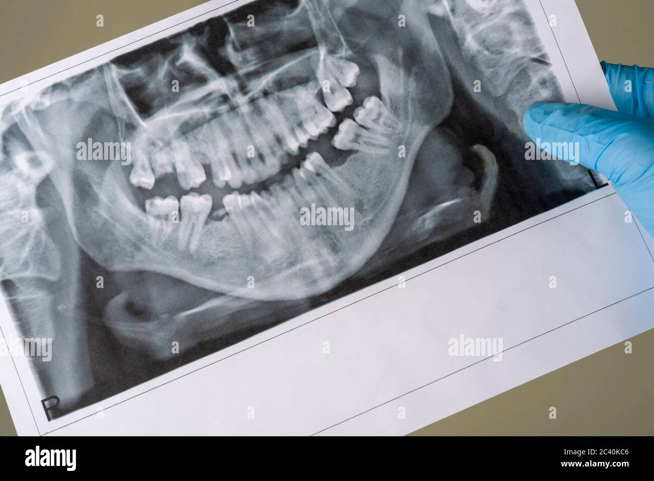 Dental X-Ray. A panoramic x-ray of a mouth, with red painful area. The doctor holds a picture of the teeth. Stock Photo