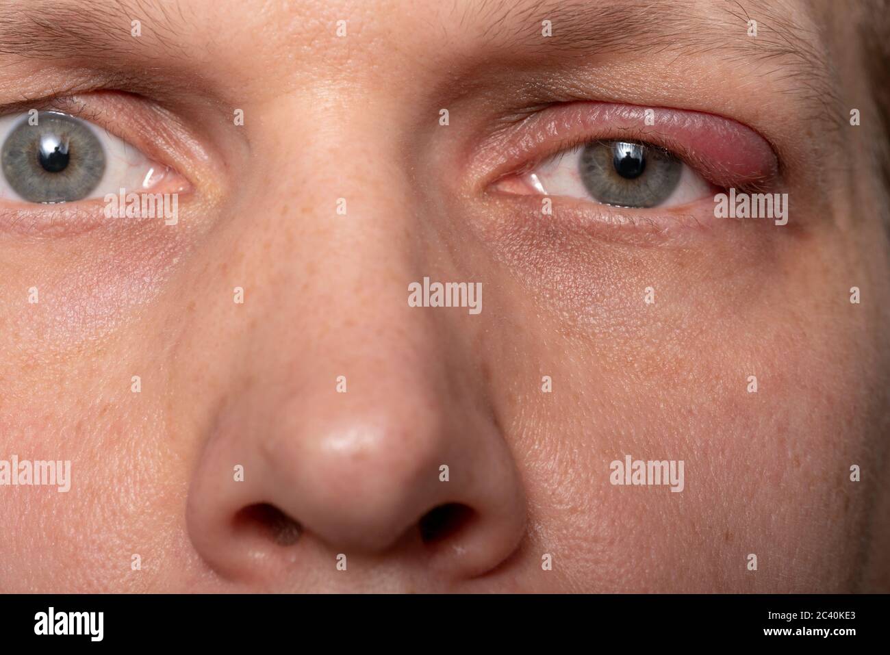 Close the upper left eyelid abscess. Eye with barley. Barley diseases, the concept of disease development. Stock Photo