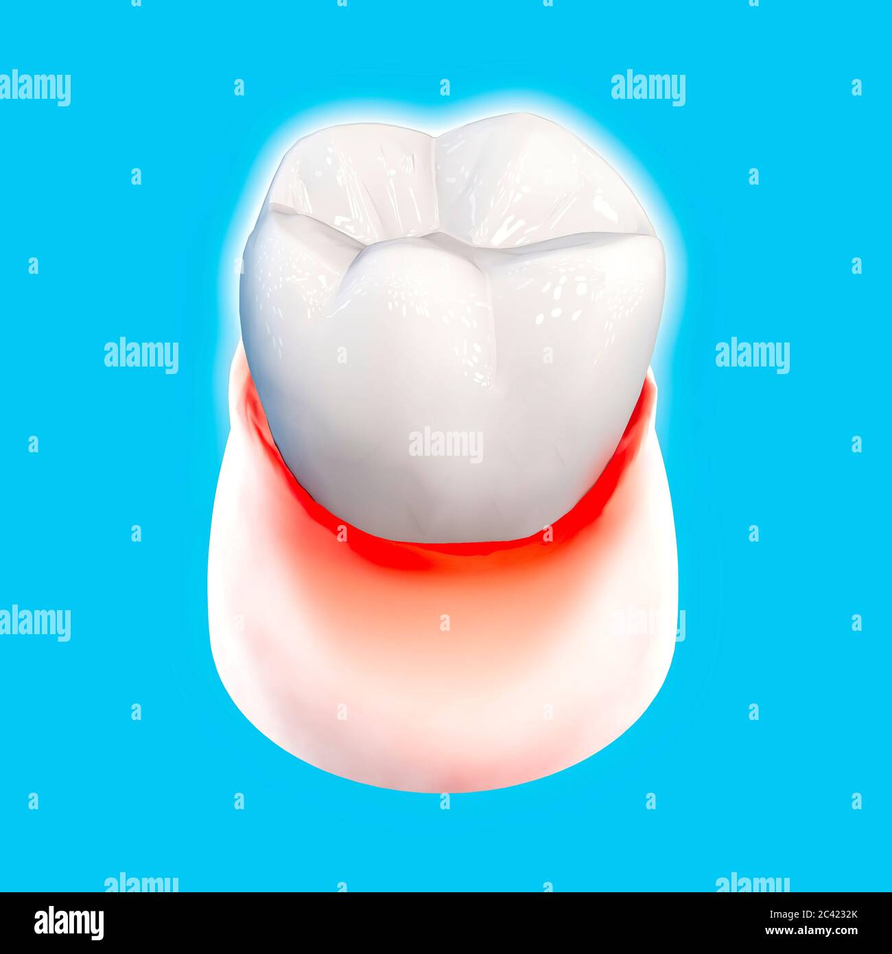 Tooth, sore gum, redness, dentistry, dental cleaning, oral hygiene