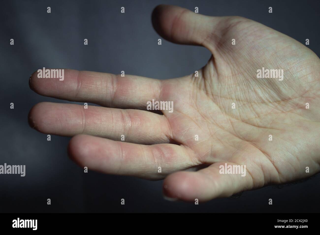 Hand with small calluses after a hard session on the climbing gym Stock