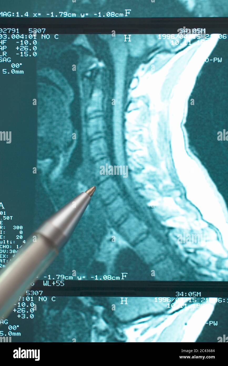 Ballpoint pen lies on x-ray Stock Photo