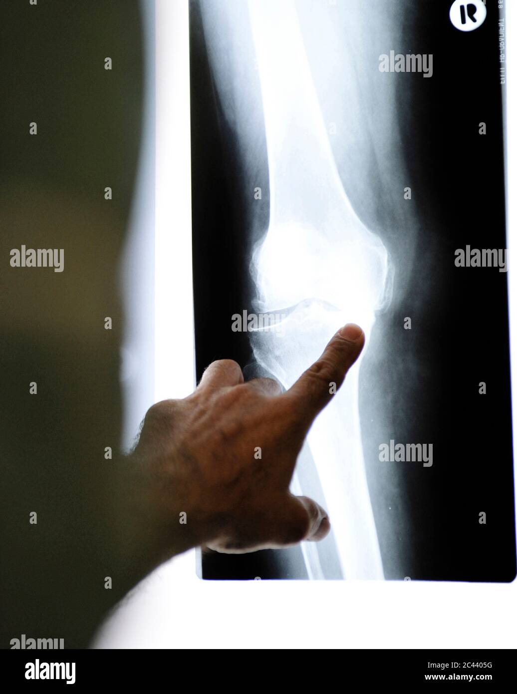 Doctor examines x-ray image of a knee joint Stock Photo - Alamy