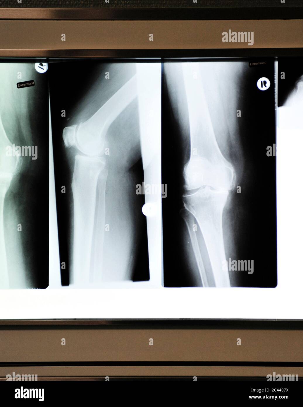 X-ray image of a knee joint Stock Photo - Alamy