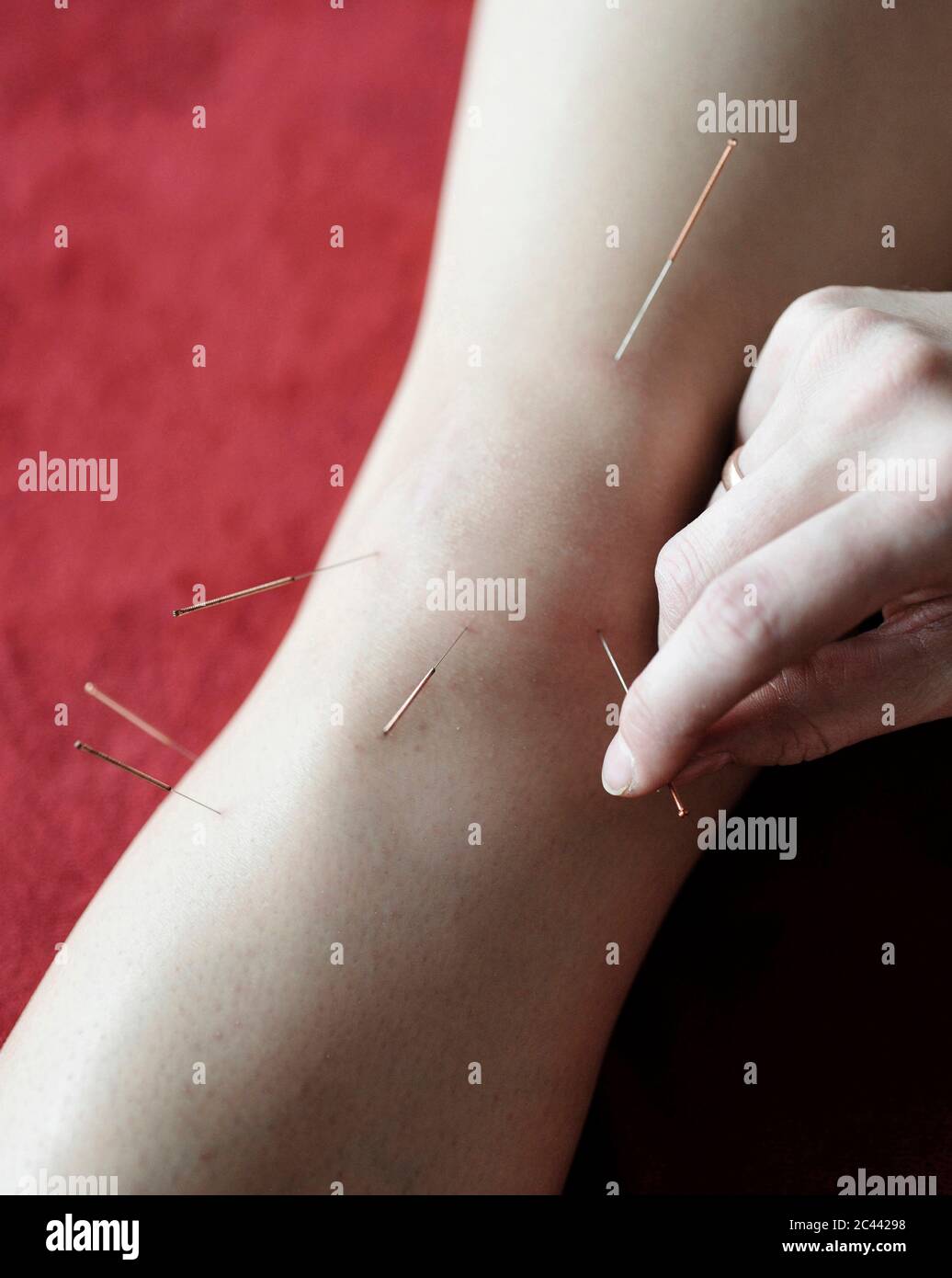 Woman acupuncture knee hires stock photography and images Alamy