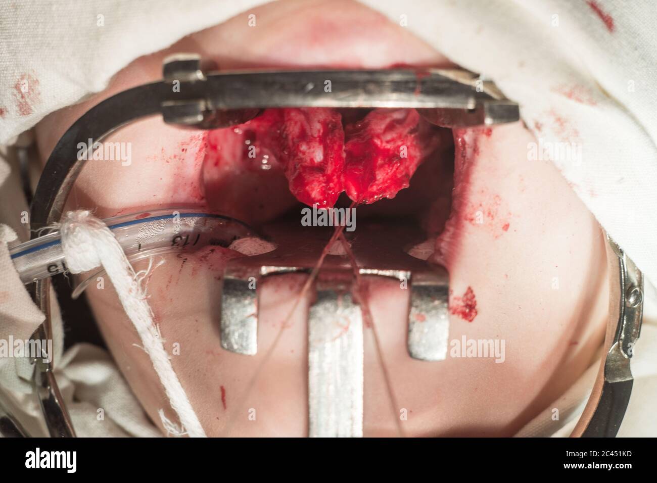 one of the stages of surgery for cleft palate in children. Mouth open with conservative, bloody wounds. Operative dentistry Stock Photo