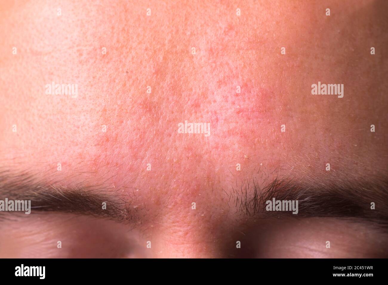 weeping eczema in the stage of exudation. Closeup of forehead area with eczema rash clinic Stock Photo