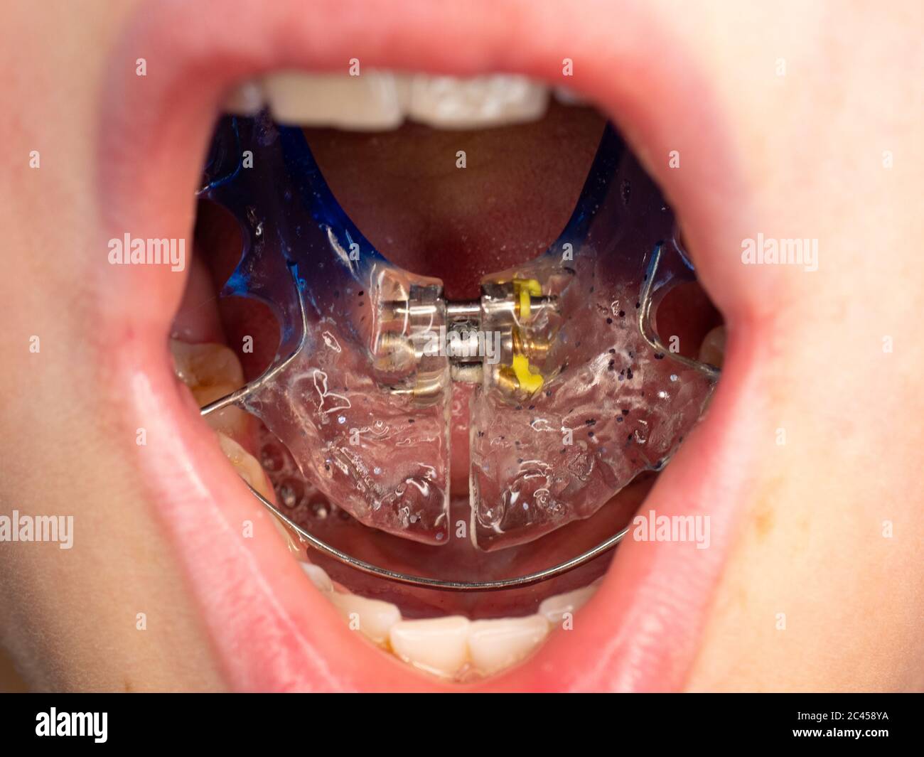 Boy show acrilic braces with stainless wire around on his tongue
