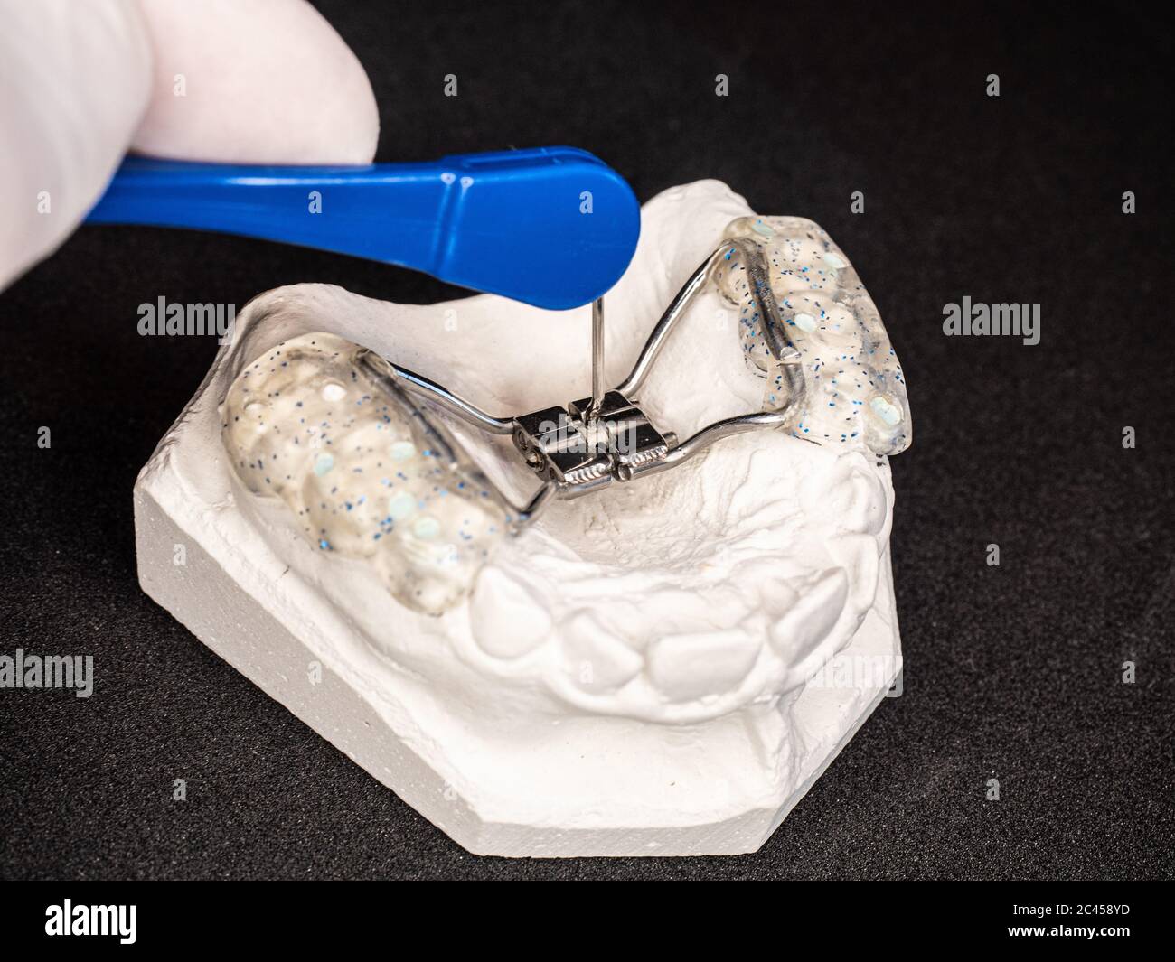 Setting of orthodontic appliance. Colored and glittered upper teeth