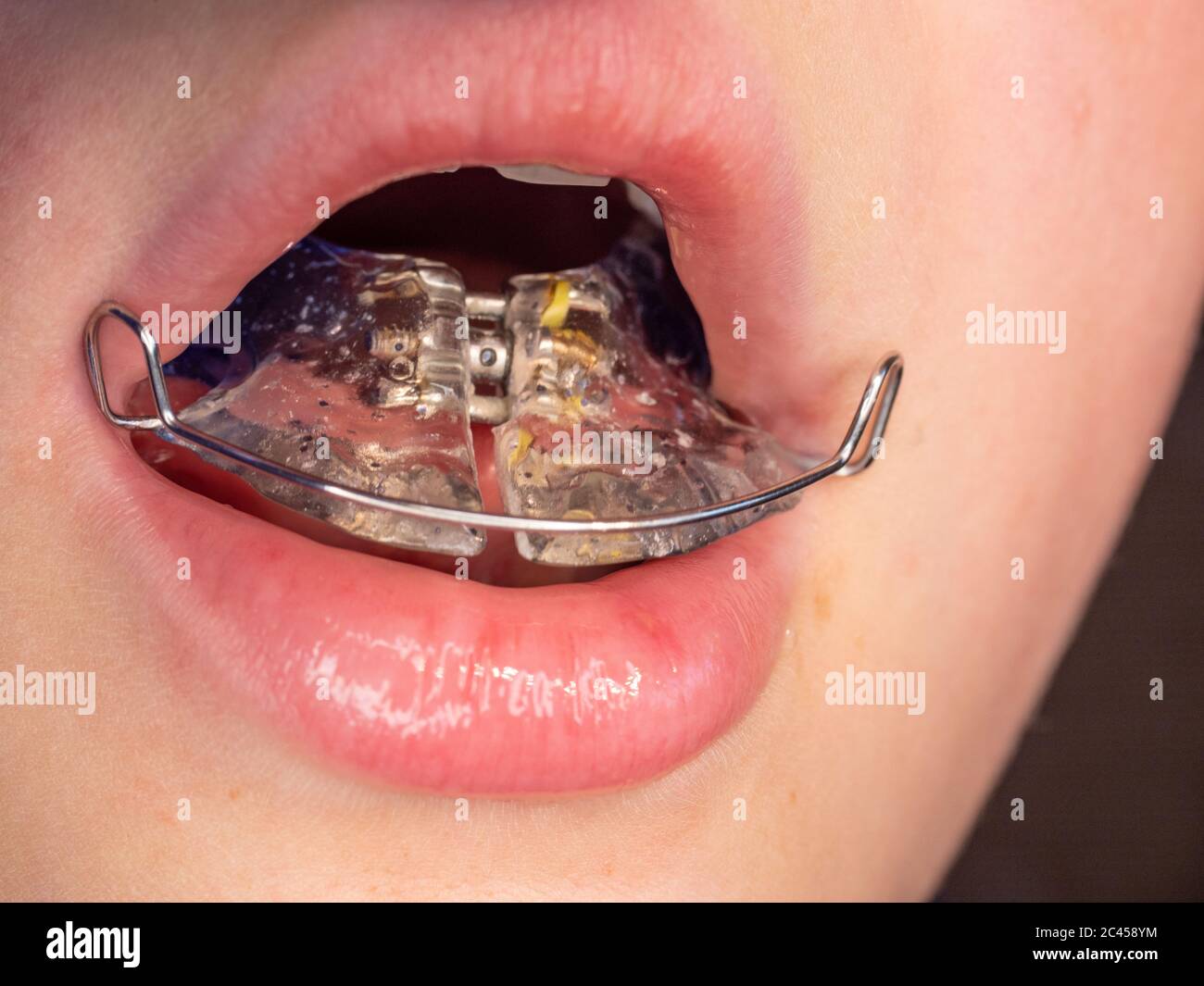 Removable Palatal Expander