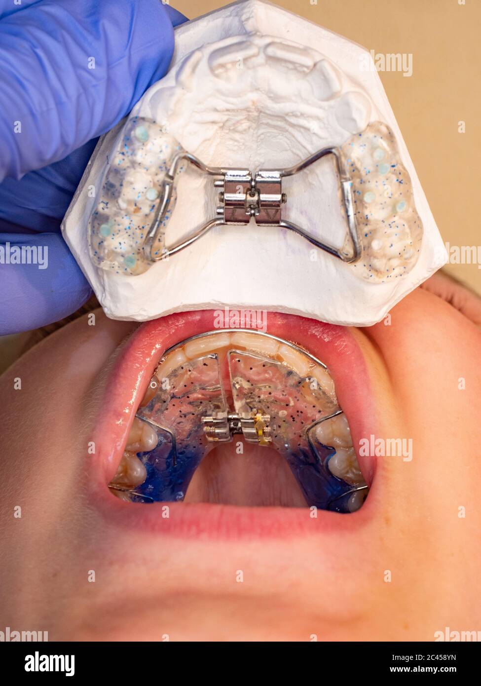 Doctor check retainer orthodontic correction in mouth. Methods of Teeth
