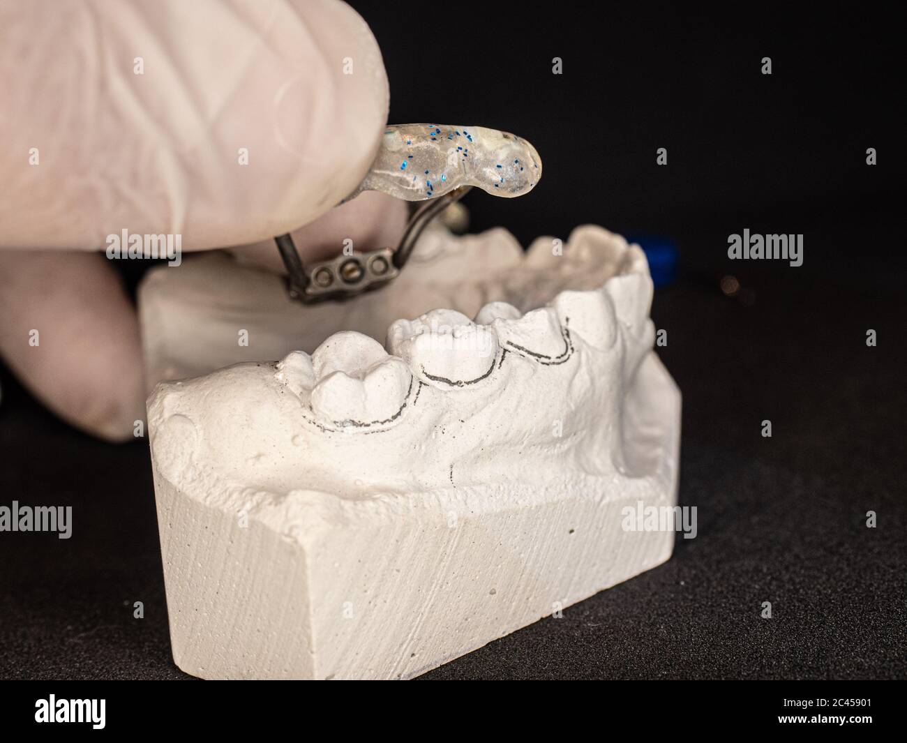 Palatal expander for the maxilla, setting test. The removable