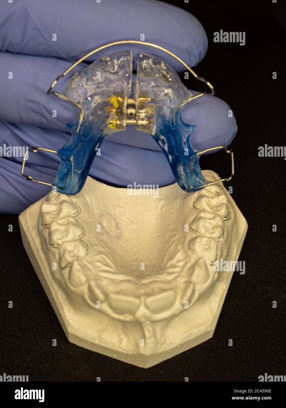 Dental gypsum models and dental brace. Dental Blue Removable Brace or Retainer for upper platal teeth Stock Photo