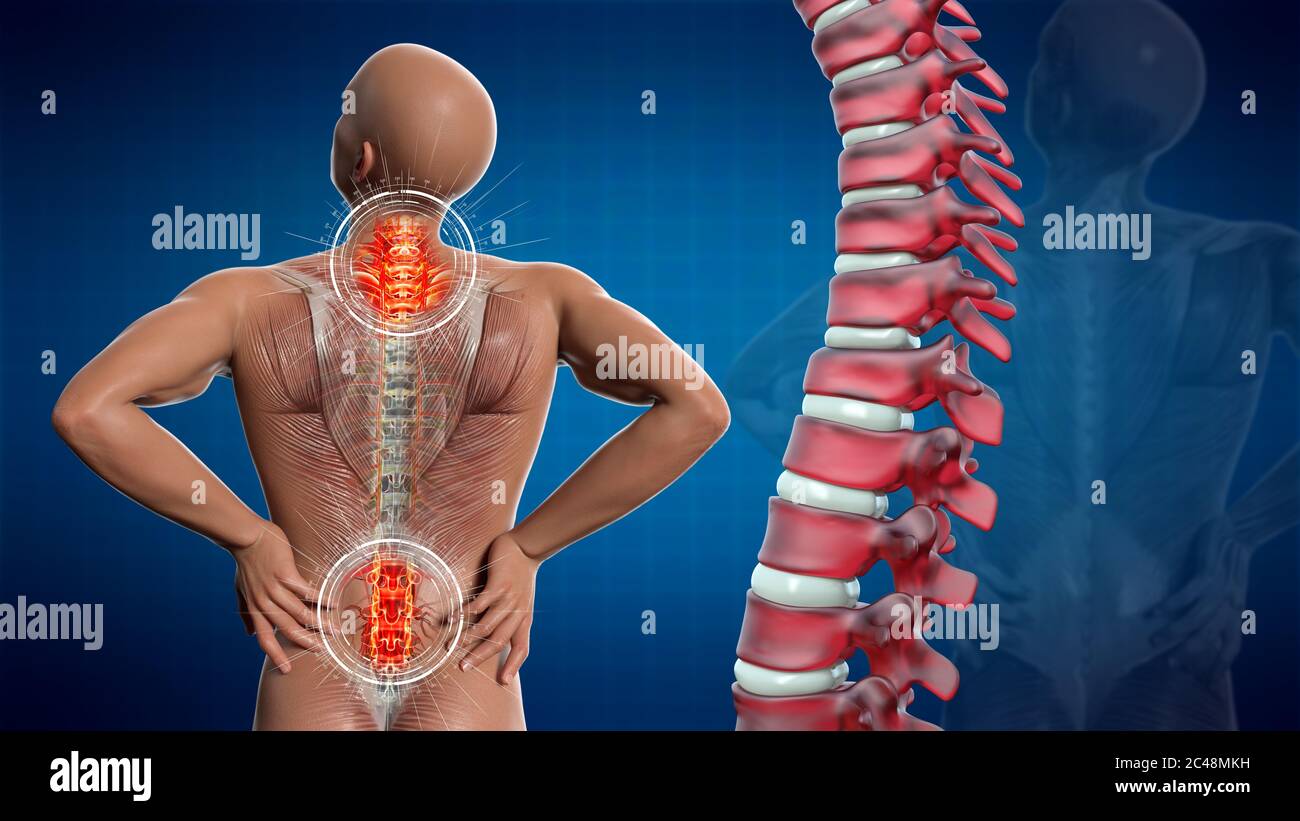 Anatomical vision back pain. Spine anatomy. 3D illustration Stock Photo ...