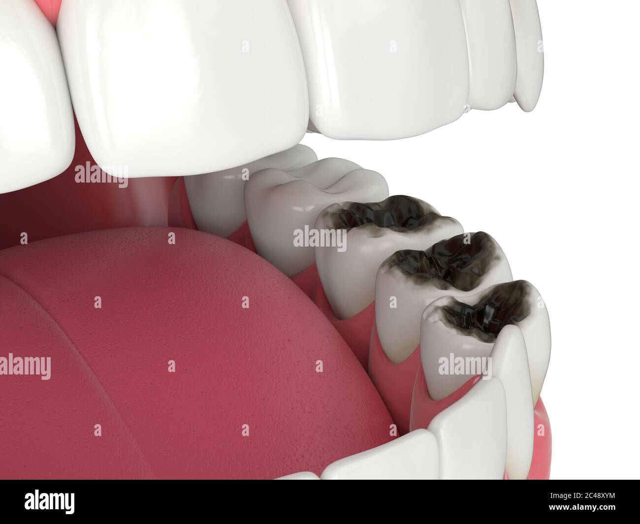 3d render of jaw and teeth with caries over white background Stock ...