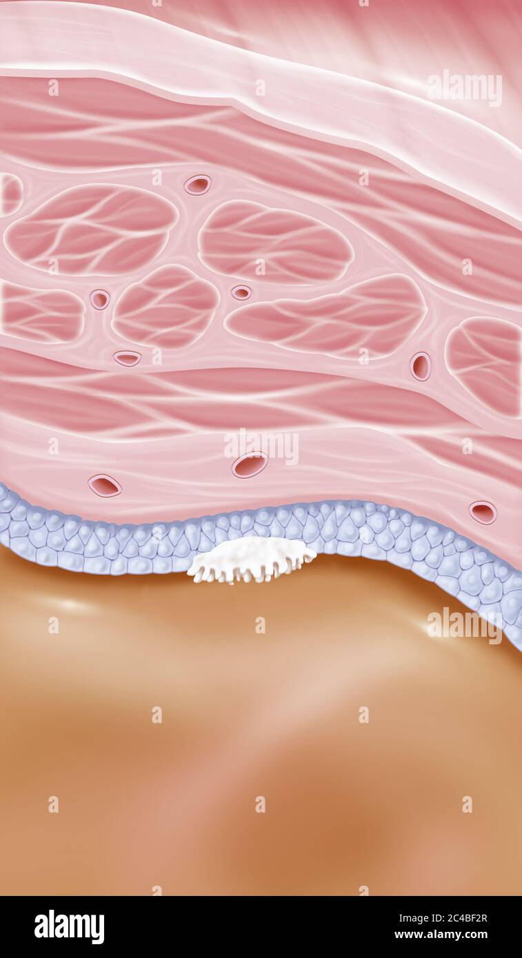 Stage 0a superficial bladder cancer. This illustration shows a zoom at the level of the bladder wall with all its structures. From bottom to top we ha Stock Photo